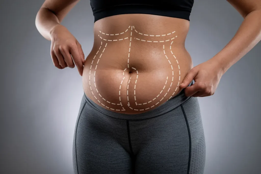 is lipo belly worth it? here’s the answer!